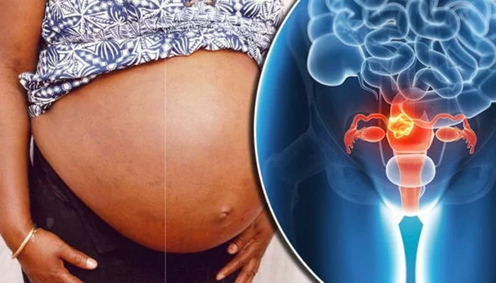 how-fibroids-affect-pregnancy-1